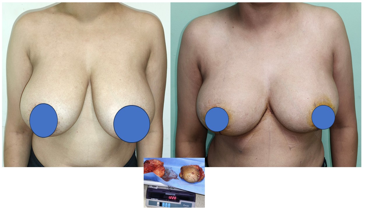 Breast Reconstruction Photo 7